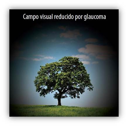 4. nervio optico glaucoma 2